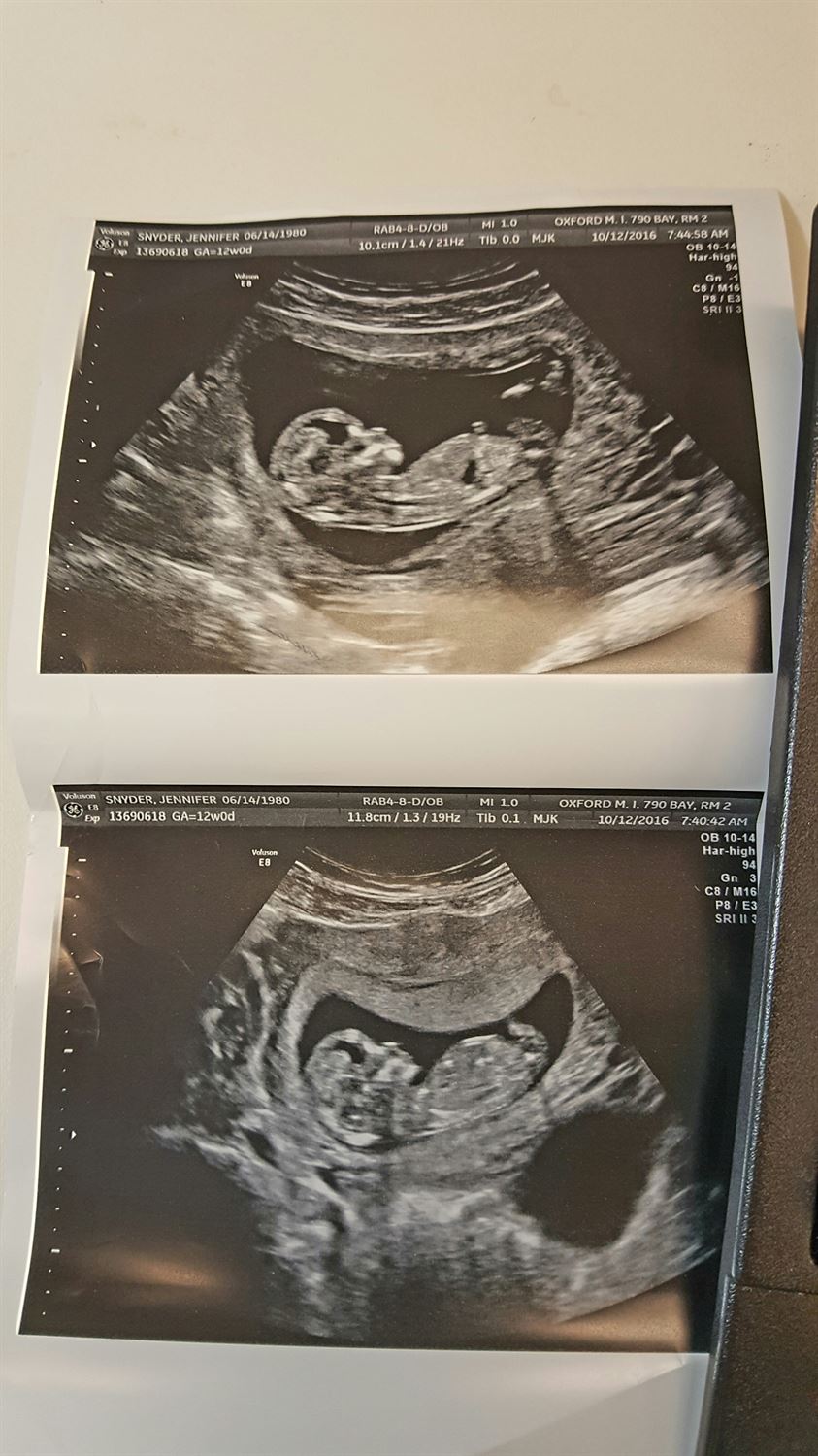 Ultrasound